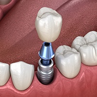 Diagram showing a single tooth dental implant in Asheville