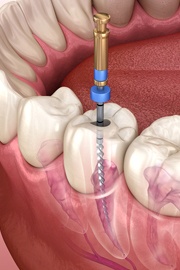 Illustration of file used to perform root canal therapy