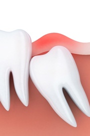 An impacted wisdom tooth