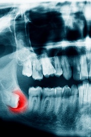 An X-ray of impacted wisdom teeth