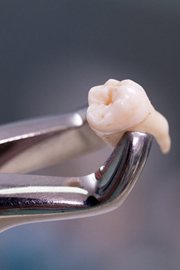 A pulled tooth