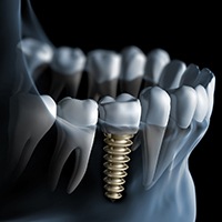 X-ray diagram of dental implants in Asheville