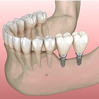 Diagram showing mini dental implants in Asheville
