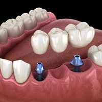 Diagram showing implant bridge replacing multiple missing teeth in Asheville