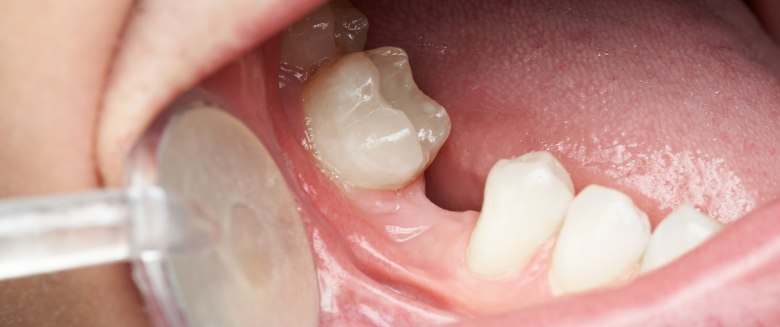 Close up of mouth with missing teeth in Asheville