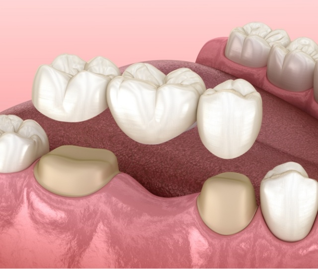 Illustration of dental bridge being placed on lower teeth
