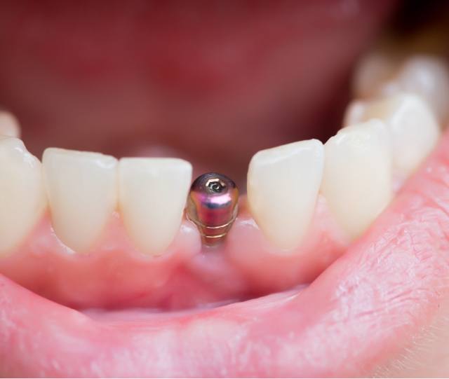 Close up of dental implant post in lower arch