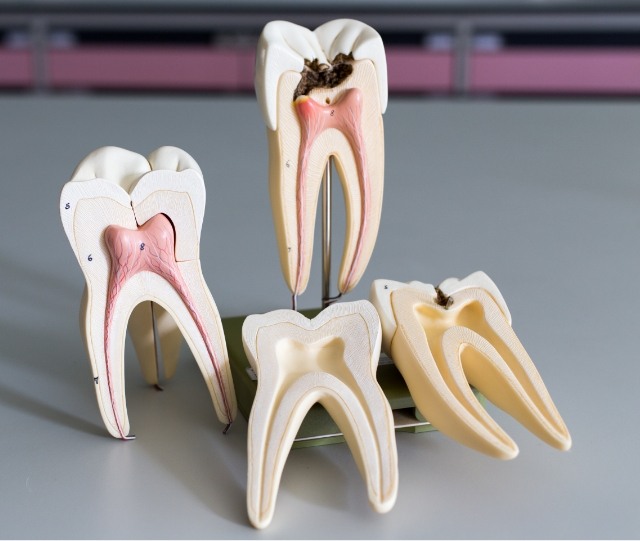 Model of decayed teeth showing root canal