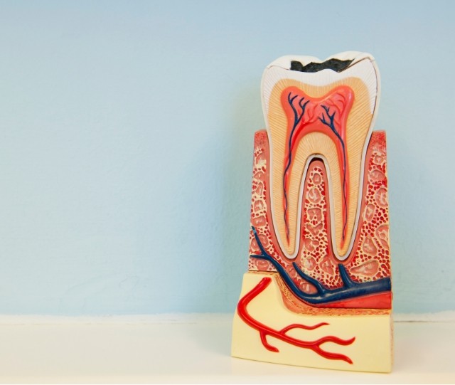 Model of a tooth suffering from severe cavity