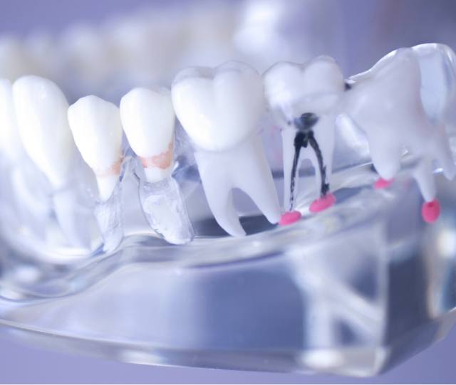 Model of infected tooth in tray with other model teeth