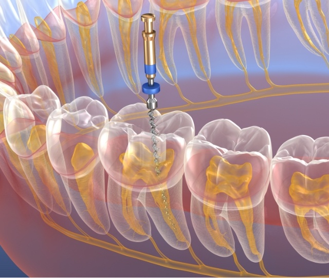 Illustration of root canal treatment in Asheville