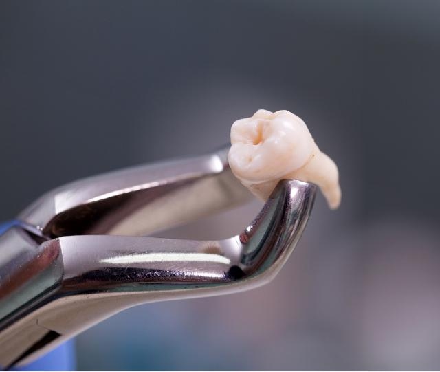 Forceps holding tooth after tooth extraction in Asheville
