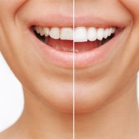 Closeup of woman's smile before and after veneers 