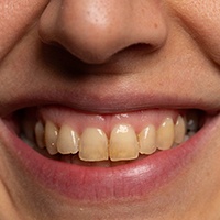 Closeup of a set of yellow teeth