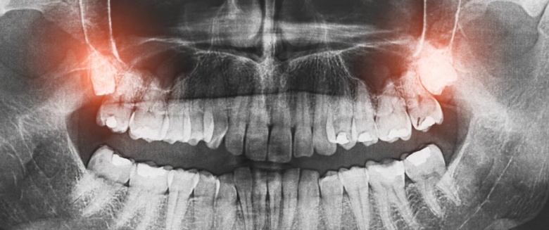 X ray showing impacted wisdom teeth
