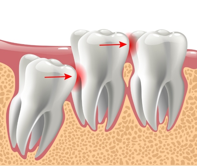 Illustration of impacted wisdom tooth in Asheville