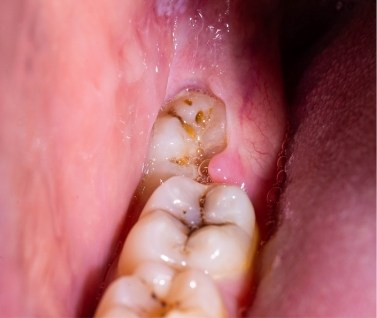 Close up of partially impacted wisdom tooth