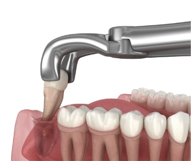 Illustration of lower wisdom tooth being extracted