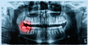 X-ray of wisdom tooth